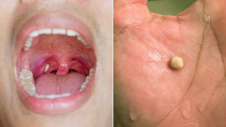 Here’s what you need to know about tonsil stones – the weird pimple-like growths in your throat